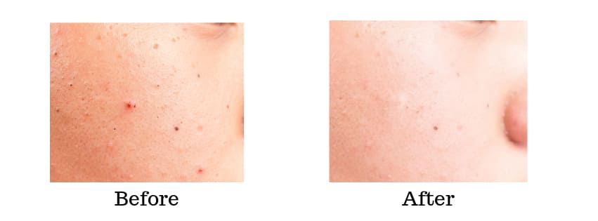 ミレム　ビュートリックを使用前と使用後のお肌